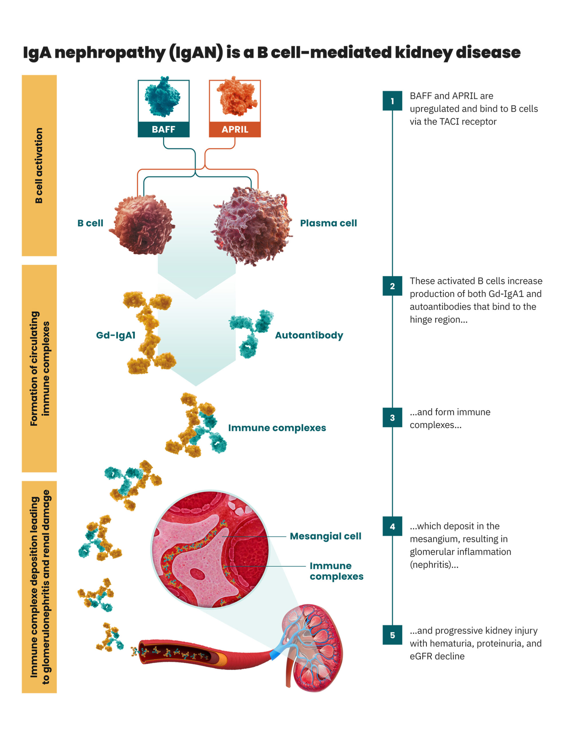 Illustration of the steps in IgAN pathogenesis, from B cell activation to the formation of immune complexes and their deposition in the kidney